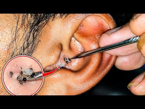 👉 Satisfying Ear Blackhead Extraction | Deep Pore Cleaning