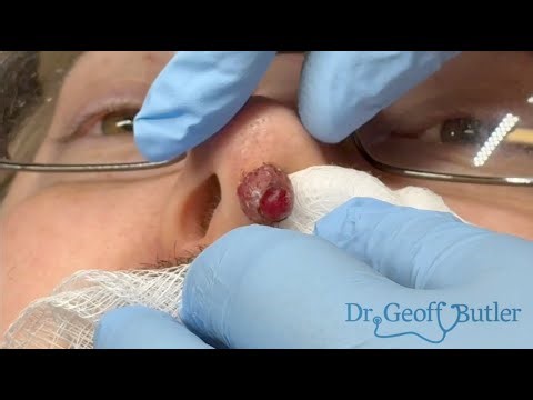 Removal of a pyogenic granuloma in the nostril