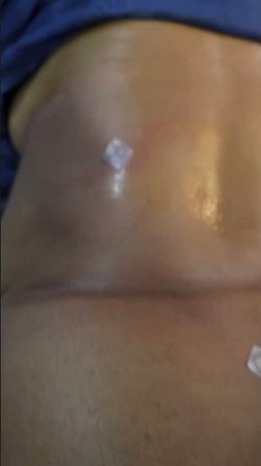 Lower Back Liposuction result #shorts