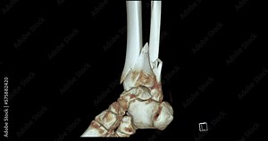 CT Scan of Ankle joint 3D rendering showing tibia and fibula bone fracture.