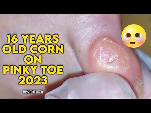16 YEARS OLD SUPER PAINFUL CORN REMOVAL 2023 BY FOOT SPECIALIST PODIATRIST MISS FOOT FIXER