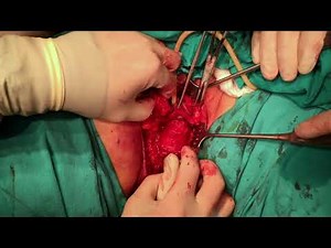 Radical Vulvectomy with Inguinofemoral Lymph Node Dissection with Rhomboid Flap