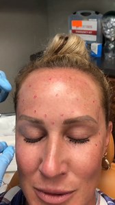 We are treating this patient using Xeomin. Now some people may ask "what exactly is the difference between Botox & Xeomin?" Well, like Botox & Dysport, Xeomin is a botulinum toxin type A that is approved to treat wrinkles. They work the same way in that both block signals from nerves to muscles, causing the muscles to relax & the wrinkles to smooth out. The main "difference" between the 2 is that Botox has an accompanying, inactive protein, while Xeomin does not have additives. As an injector, i