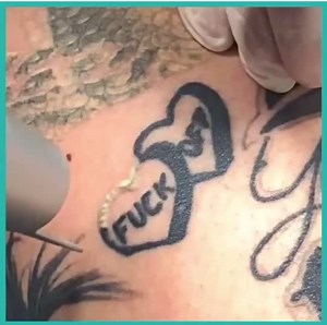 👋 #lasertat #fyp #lasertattooremoval #laser #tattoo #adelaide #tattooremoval #oddlysatisfying #satisfyingvideos #legtattoo #tattooremoval