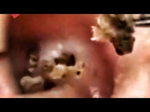 Whiteheads! Biggest Pimples Popping and Top 10 Comedones! Zits