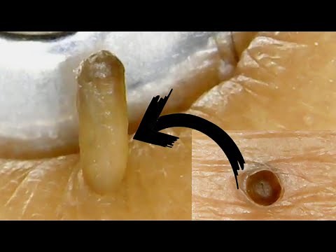 Blackheads Removal|Close-up Extraction