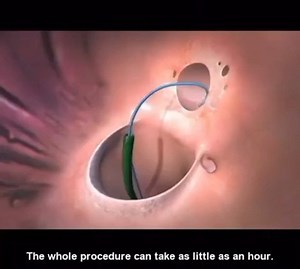 Atrial septal defect (ASD) closure with the helex septal occluder. An ASD is a open communication in the septum between the left and right atriums. This condition is typically congenital. This opening can allow for oxygenated blood to pass over into the right side of the heart causing more right sided stress over time. What is the most common type of ASD? Follow @cardiovisual for more educational content ❤️❤️ . . . . . #heart #chd #chdawareness #cardiac #echocardiography #asdawareness #asd #asdm