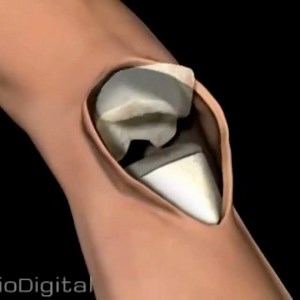 Artroplastia total de joelho. #biomedicina #anatomy #nurse #artroplastiadequadril #joelho #Fisioterapia #med #artroplastiadejoelho #enfermagem #educadorfisico #artroplastiatotaldejoelho #artroplastia #educacaofisica #fitness #artroplastiatotaldoquadril #educacaofisica #educaçãofísica #terapiamanual #treino #crossfit #physicaltherapy #edfisica #medicine #medical #musculação #musculacao #academia #treinofuncional | Fisioterapia Hospitalar