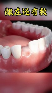 【德国正品】慕斯牙齿松动牙龈肿痛萎缩牙痛牙晃固齿片牙周护理