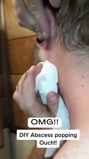 Newest Pimple Pops for 2022 - Cystic Acne Popping 2022