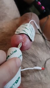 Electro tens, custom urethral probe