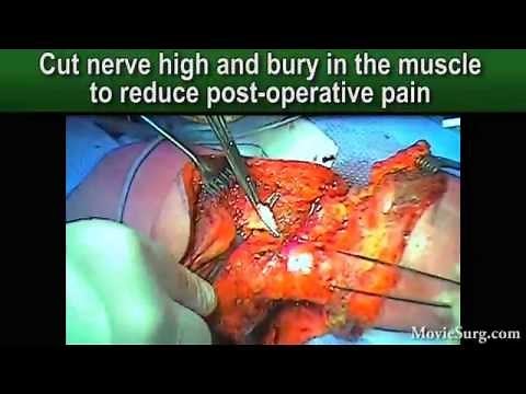 MovieSurg - Above knee amputation