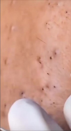 Satisfying Blackhead Removal ASMR