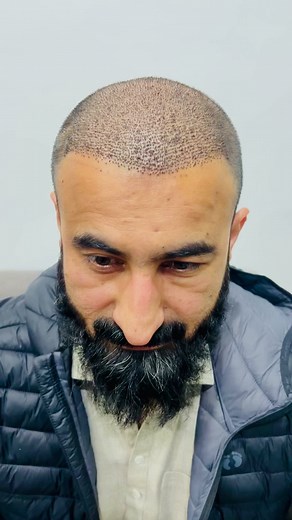 9.2K views · 197 reactions | 7 Days Post-Hair Transplant: The REAL...