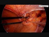 Laparoscopic Inguinal Hernia Repair in Female • Video • MEDtube.net