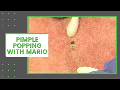 Pimple Popping with Mario | Dr. Derm
