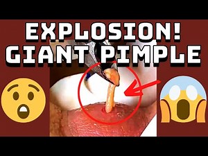 Giant Pimple Explosion Cyst Popping | Acne Pus Blackheads Bursting | ASMR Satisfying 33# 😱😱