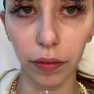 FEMALE LIP AUGMENTATION