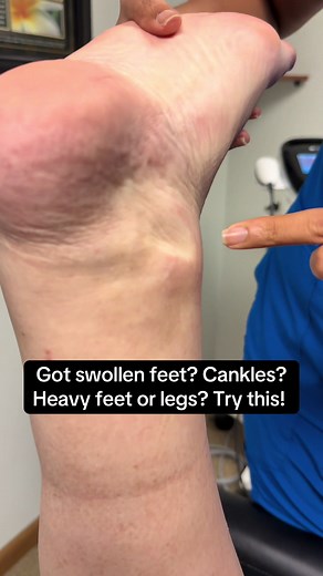 Reduce Swollen Feet & Pitting Edema: Simple Daily Relief