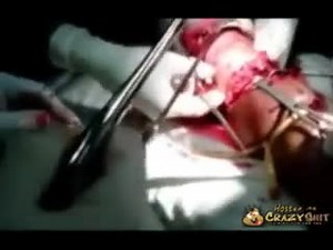 CrazyShit.com | Hacksaw Arm Amputation