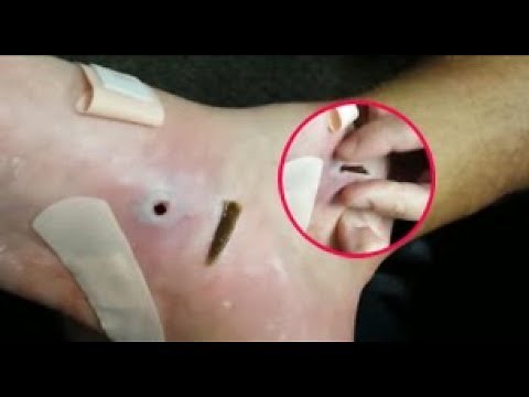 Splinter Removal Video - Master of Splinter