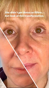 She didn’t get Botox. She didn’t get filler. But her skin? Transformed. This is collagen regeneration at its best—real results using technology such as Morpheus8 RF microneedling and LaseMD fractional laser. These advanced, non-surgical treatments tighten skin, reduce fine lines, improve texture, and build your skin from within. No filters. No toxic injectables. Just natural, long-lasting anti-aging results. At Natural Rejuvenation MedSpa, we specialize in personalized, holistic treatment plans 