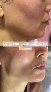 5.3K views · 20 reactions | ✨ HIFU = Lifting sans chirurgie! ✨ من أوّل سيانس تشوف • الوجّه يشد ☝️ • الـ contour يطلع • الخطوط تتخفّف • و effet lifting immédiat  تقنية آمنة، بلا جراحة، بلا downtime… والـ résultat يكبر مع الوقت ❤️ | Bibi Skin Care International Academy By Feriel | Facebook