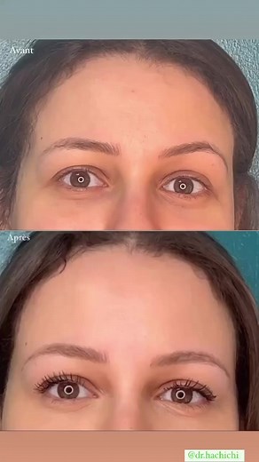 Botox front et pattes d’oie: embellissent et ouverture du regard, suppression des rides, peau tendue et lumineuse, charisme, rafraîchissement et rajeunissement assurés 🔥🔥🔥 retrouvez la beauté de vos yeux et la fraîcheur de votre regard comme à 20 ans 💉🧚🔥 “SOYEZ LA MEILLEURE VERSION DE VOUS MÊME” 🥰 | Dr.Hachichi