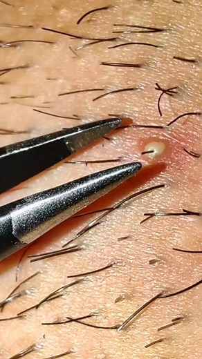 Hair Tweezers ASMR Videos: Satisfying Hair Removal & Blackhead Extraction