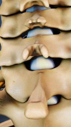 Use this quick guide to understand why cervical degenerative disc disease can cause a stiff neck and what you can do to relieve the pain! 💆‍♂️💥 Learn about symptoms, common causes, and effective treatments to improve your neck mobility and prevent future flare-ups. 🩺✨ | Spine-health