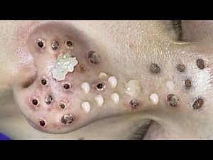 Blackhead Removal With Sac Dep Spa @100074567