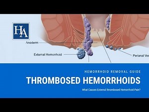 Thrombosed Hemorrhoids - What Causes External thrombosed Hemorrhoid Pain?