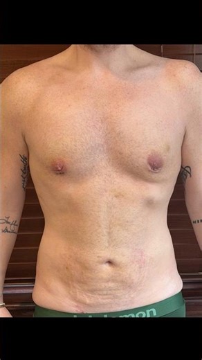Pre-Op vs. 2 Weeks Post-Op #bodytransformation #plasticsurgery #male #beforeandafter #results #tgif