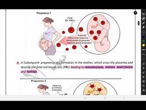 obstetric/Rh-isoimmunization p2