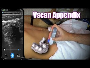 ‪@GEVernova‬ Vscan Appendix Live demo
