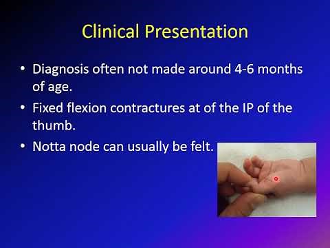 Congenital Trigger Thumb