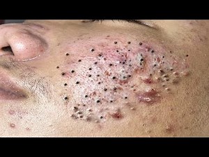 Blackhead Removal With Sac Dep Spa @100074606