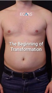 🌟 Transform Your Practice with Hi-Def Liposuction Training! 🌟🔍 Precision Body Contouring: • Master advanced hi-def liposuction techniques. • Hands-on experience with live models. • Deep dive into anatomy for natural, stunning results.💡 Training Highlights: • Comprehensive coverage for male & female contours. • Focus on patient care, fat grafting, and muscle definition. • Safety and complication management.🎓 Expert-Led Courses: • Learn from top surgeons in the field, Dr. KANDULU. • Access to