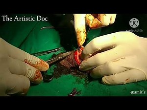 Case of Phimosis | Surgical Techniques of Circumcision