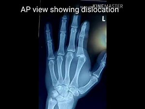 Open Metacarpophalangeal Dislocation of the Index Finger | Reduction Technique (Orthopedic Surgery)