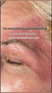 #wrinkles #fibroblastskintightening #SkinTightening #zonuniscretskincare💕 | Zonuni Skincare