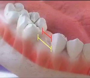 Space maintainer is important to save the space for the permanent tooth to erupt in its proper position after the baby tooth has been extracted. #harvandental | Harvan Dental Clinic | Facebook