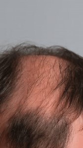 Doctor Black Gloves Performing Scalp Injection Stock Footage Video (100% Royalty-free) 4000691367 | Shutterstock