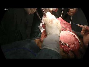Peritoneal Flap with TAR for a Complex Ventral Hernia • Video • MEDtube.net