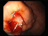 Gastric Varices - Endoscopic Ablation With Cyanoacrylate Glue (9 of 18) • Video • MEDtube.net