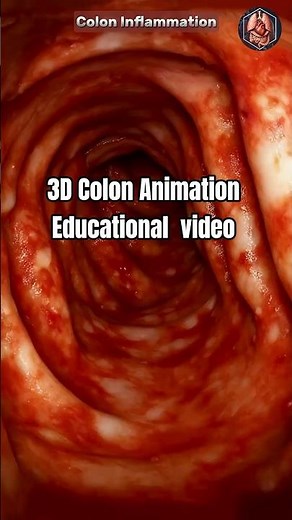 Inside Ulcerative Colitis 3d View of Colon Inflammation #digestivehealth #3danimation #shorts
