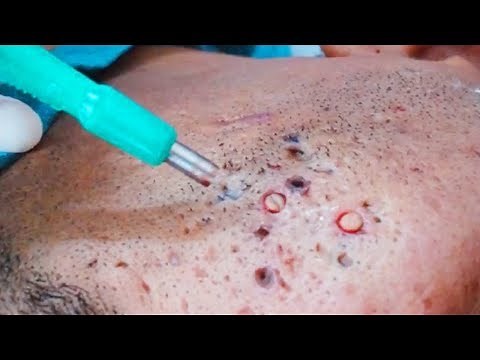 I have the world's worst acne, blackheads, pimples and zits | Blackhead King
