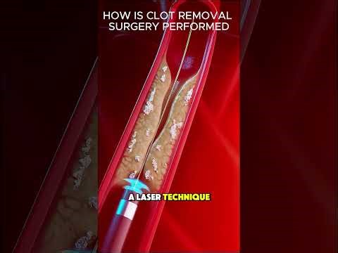 How to perform a thrombus removal surgery
