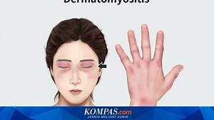 Penyebab Dermatomiositis yang Mirip dengan Penyakit Autoimun Kulit