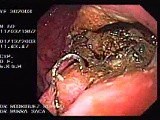 Cyst-Gastrostomy (2 of 5) • Video • MEDtube.net
